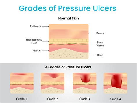 What Are The 4 Main Types Of Pressure Ulcer The Epuap Pressure Ulcer