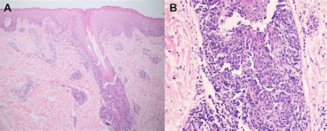 Histopathology Of Lymphomatoid Papulosis Type F A Superficial And