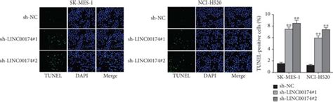 LINC00174 Depletion Suppresses The Malignant Behaviors Of LUSC Cells