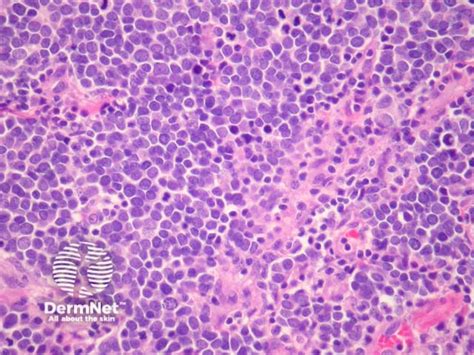 Merkel Cell Carcinoma Pathology