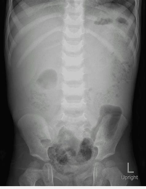 Digital X Ray Of The Abdomen In Upright Position Revealing No Evidence
