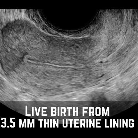 Uterine Lining Measurements The Uterine Lining And Implantation Of An