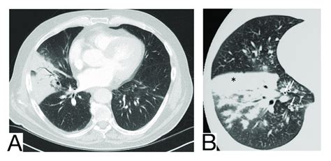 A Consolidation With Air Bronchogram In A Patient With Bacterial Download Scientific Diagram