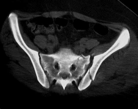 Pelvic Ring Fractures 네이버 블로그