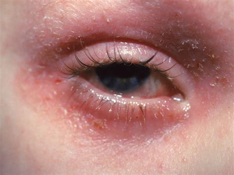 Eyelid Dermatitis Eczema Symptoms Causes And Treatment Off