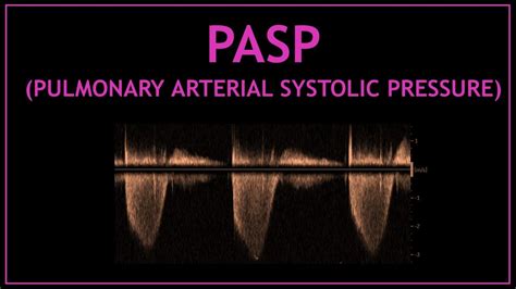 PASP Pulmonary Artery Systolic Pressure YouTube