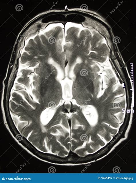 Magnetic Resonance Of Brain MR Stock Image Image Of Bones Body 9265497