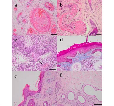 Vascular Lesions And Inflammation Visualized In Scrotal Skin Download Scientific Diagram