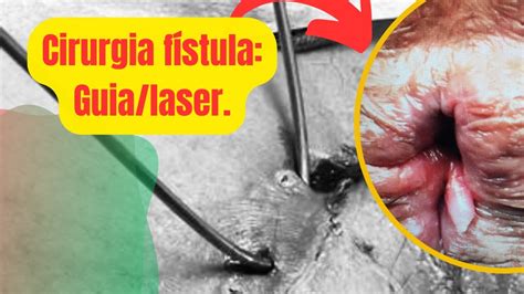 Fazendo cirurgia fístula perianal c meu guia metálico e anestesia local