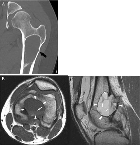 Case 7 A 27 Year Old Female Presents With Vague Thigh Pain For 1 Year Download Scientific