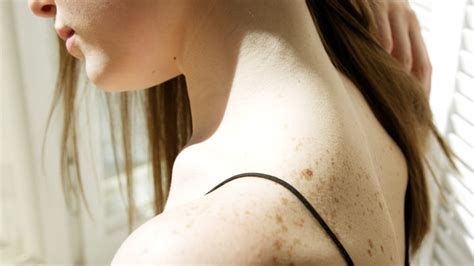 Do You Know What Is Tinea Versicolor Symptoms Causes Diagnosis Treatment And Prevention