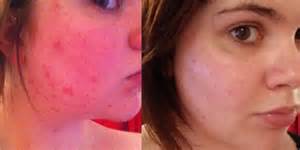 La Roche Posay Effaclar Duo Before And After Pictures