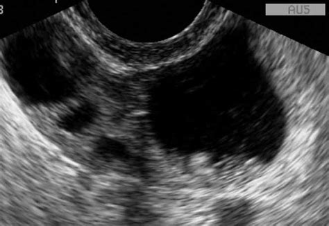 Fallopian Tube Cyst Ultrasound