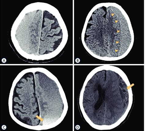 Computed Tomography Demonstrating Four Types Of Chronic Subdural