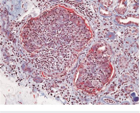 Figure From Immune Reconstitution Renal Limited Sarcoidosis