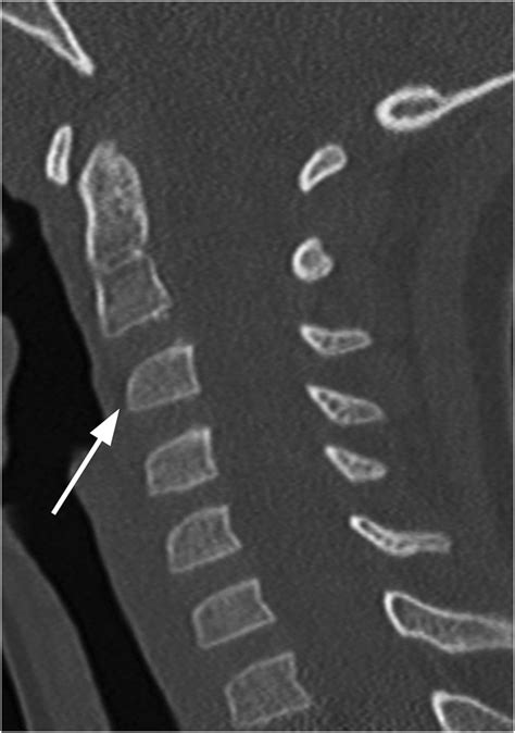 Section Specifics Of Pediatric Spinal Trauma Radiology Key