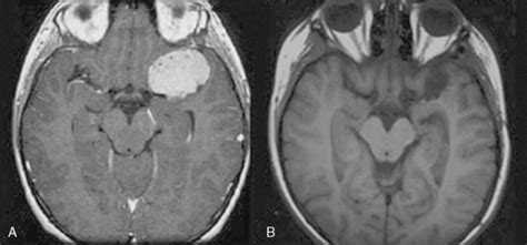 Pediatric Meningiomas Clinical Gate