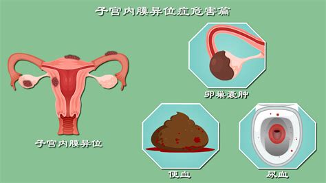 子宫内膜异位症 子宫内膜异位症的发病机制 子宫内膜异位症是怎么形成的 科普视频 在线问诊 深读视频 深度