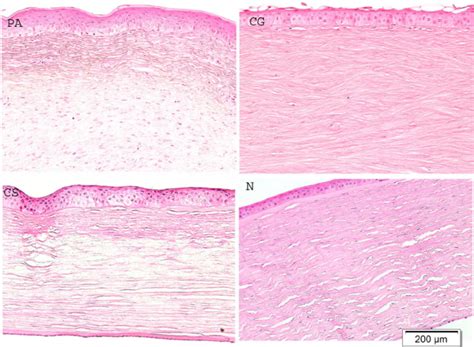 Light microscopy. Upper left: The cornea in Peters anomaly (PA). Note ...