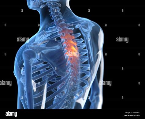 Painful thoracic spine, illustration Stock Photo - Alamy