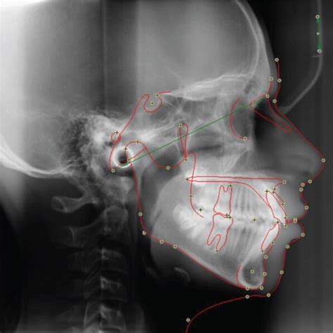 Pre Treatment Radiographs A Lateral Cephalogram With Tracing B