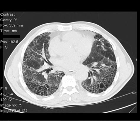 Combined Pulmonary Fibrosis And Emphysema Respiratory Care