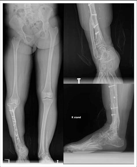 Lengthening And Deformity Correction In Vascularized Fibular Autograft