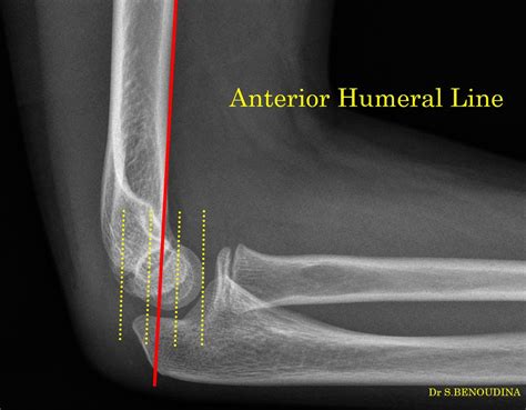 Anterior humeral line | Radiology Case | Radiopaedia.org | Radiology ...