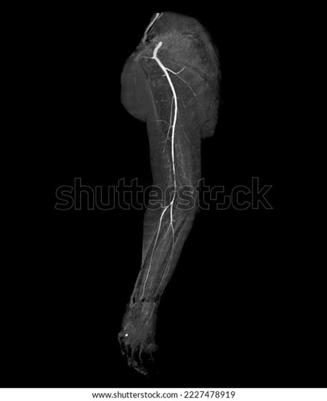 Cta Brachial Artery Ct Scan Upper Stock Illustration 2227478919