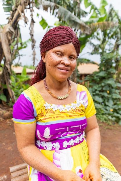 Portrait D Une Jeune Femme Albino Africaine Souriante Assise Sur Une