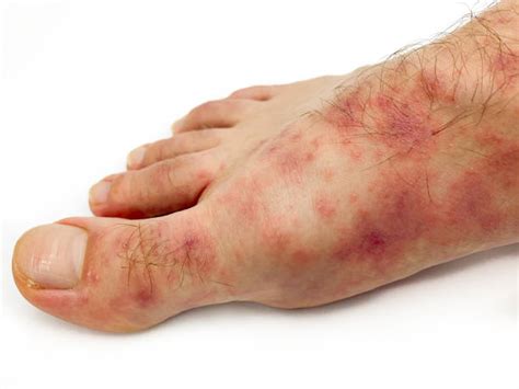 Hiv Rash