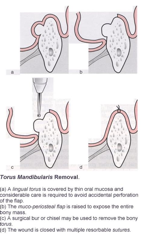 Removal Of Tori Exodontia