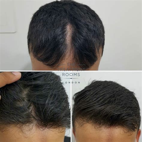 Hair Transplant Scar Repair Through Fue Treatment Rooms London