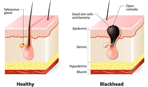 The Top Treatments To Get Rid Of Blackheads Annapolis And Severna