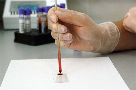 Testosterone Blood Test Results Explained, Understand Test Result