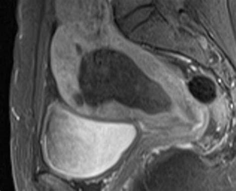 Fibroma Uterino Caso Clinico Interventix