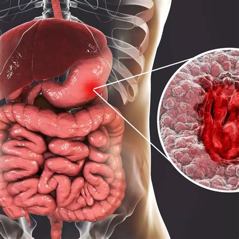 Understanding The Differences Crohns Disease Vs Ulcerative Colitis