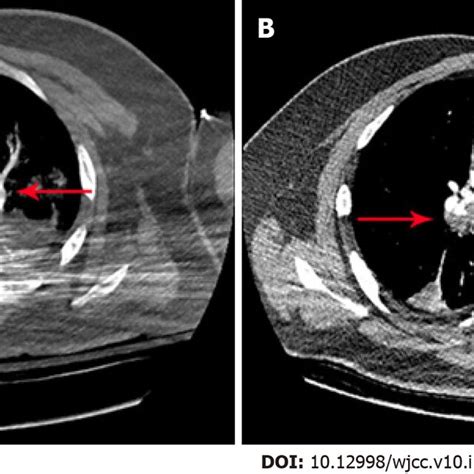 Computed Tomography Angiography Findings A Computed Tomography