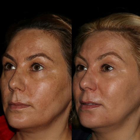 Cosmelan Peel Before After Photos Skin Matrx