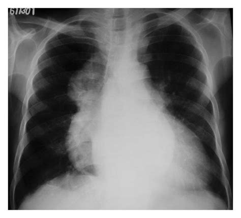 Anteroposterior A And Lateral B Chest Radiographs Showing Large