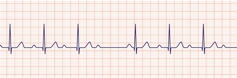 Ekg Practice Test Improve Your Skills With Our Free Online Exam