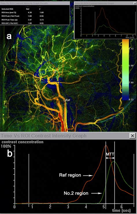 Color Coding Digital Subtraction Angiography DSA For Moyamoya Disease