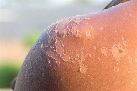 How To Get Rid Of Peeling Skin From A Sunburn Riverchase Dermatology