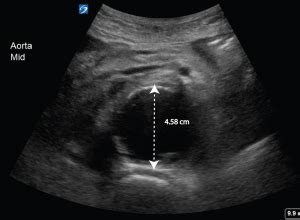 Discovering The Aorta Through Ultrasound Critical Care Sonography