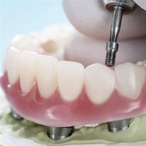 Todo Sobre Las Carillas De Composite Cl Nica Dental Casaus