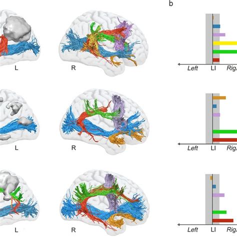 Tractography Reconstruction Of The Dorsal And Ventral White Matter