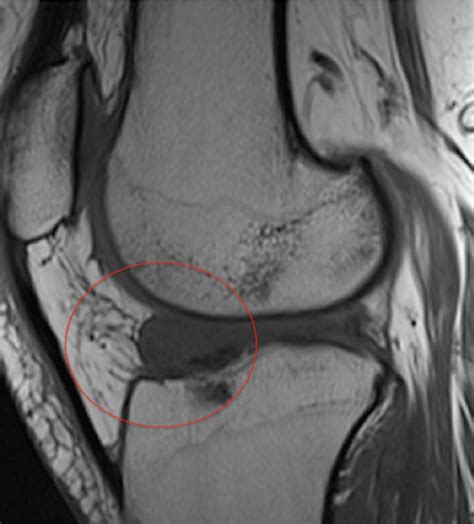 Figure 2 from Localized anterior arthrofibrosis (Cyclops lesion) with ...