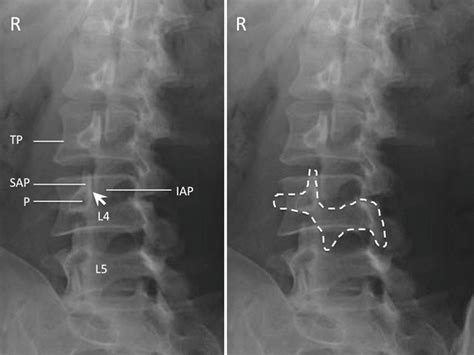 Facet Joint Nerve Block Injection