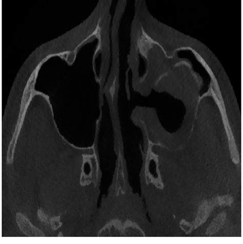 Axial Computed Tomography Image Obtained At 1 Month After Surgery The