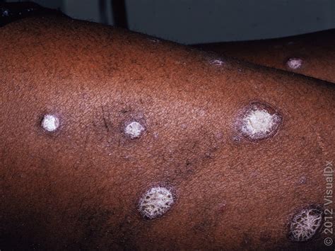 What Psoriasis Looks Like on People of Color (With Images) - GoodRx